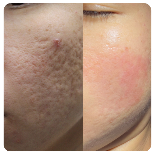 Dragon Blood Acne Scar Serum